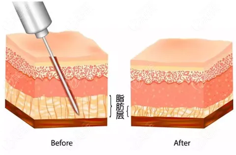 抽脂手术对身体有什么伤害？该不该禁止抽脂手术？